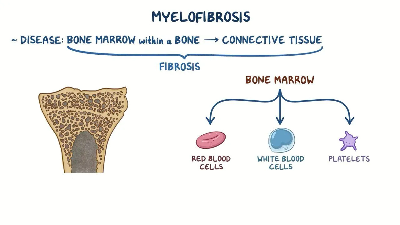 What is Myelofibrosis?