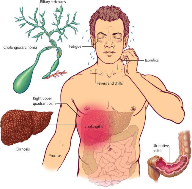 what is Biliary Cholangitis?