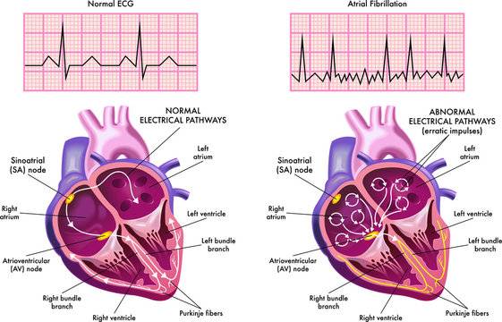 What is Atrial fibrillation?