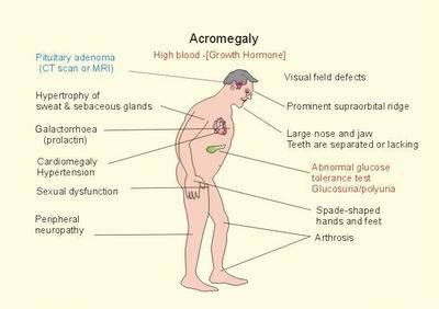 What is Acromegaly