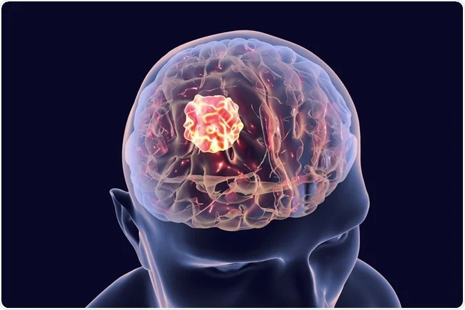 What is a Brain Tumor?