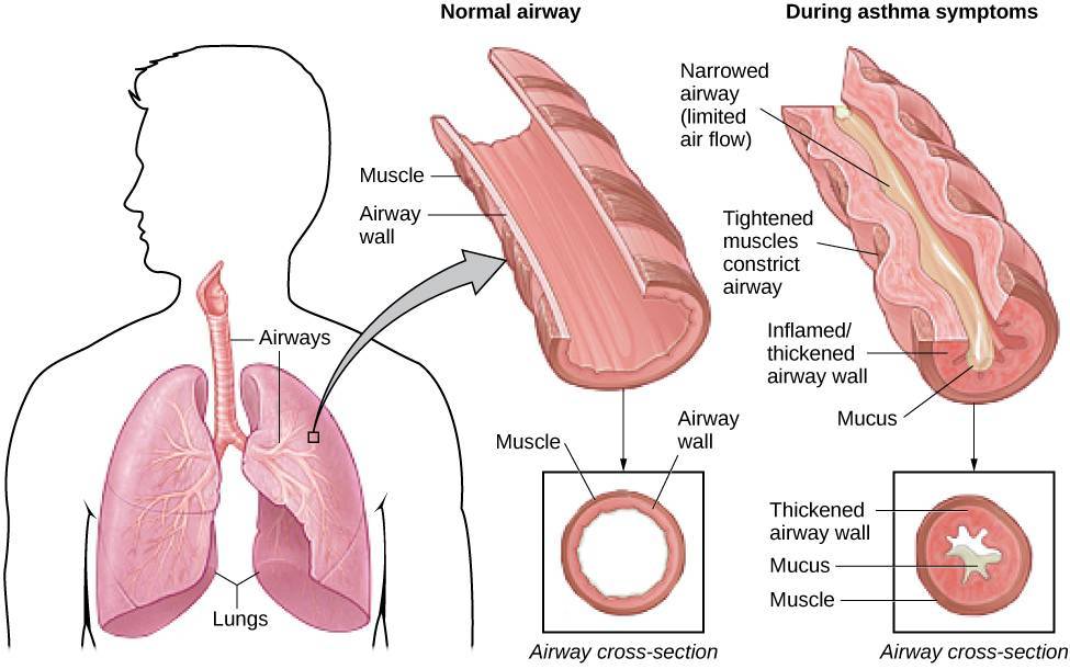 What is asthma?