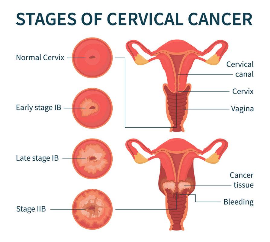 What Is Cervical Cancer?