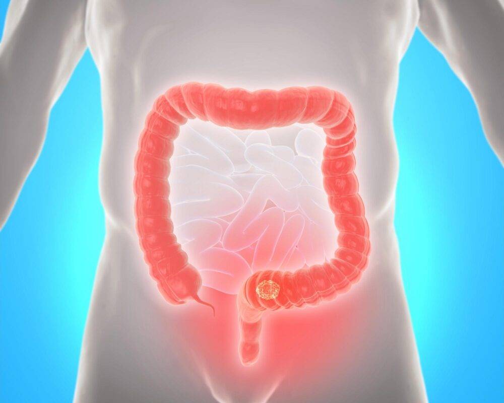 What Is Colorectal (Colon) Cancer?