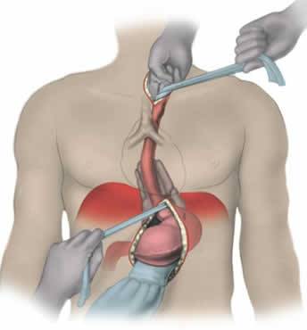 What Is Esophageal Cancer?