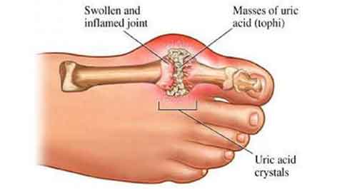 What Is Hyperuricemia?