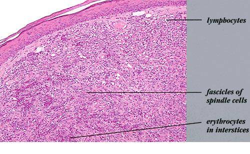 What is Kaposi Sarcoma?