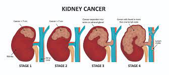 What is Kidney cancer ?