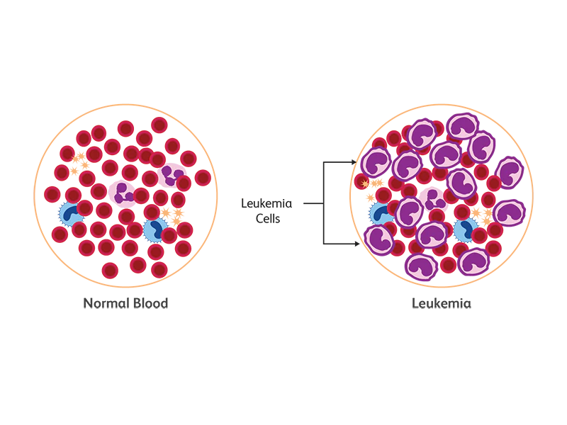 What is Leukemia ?