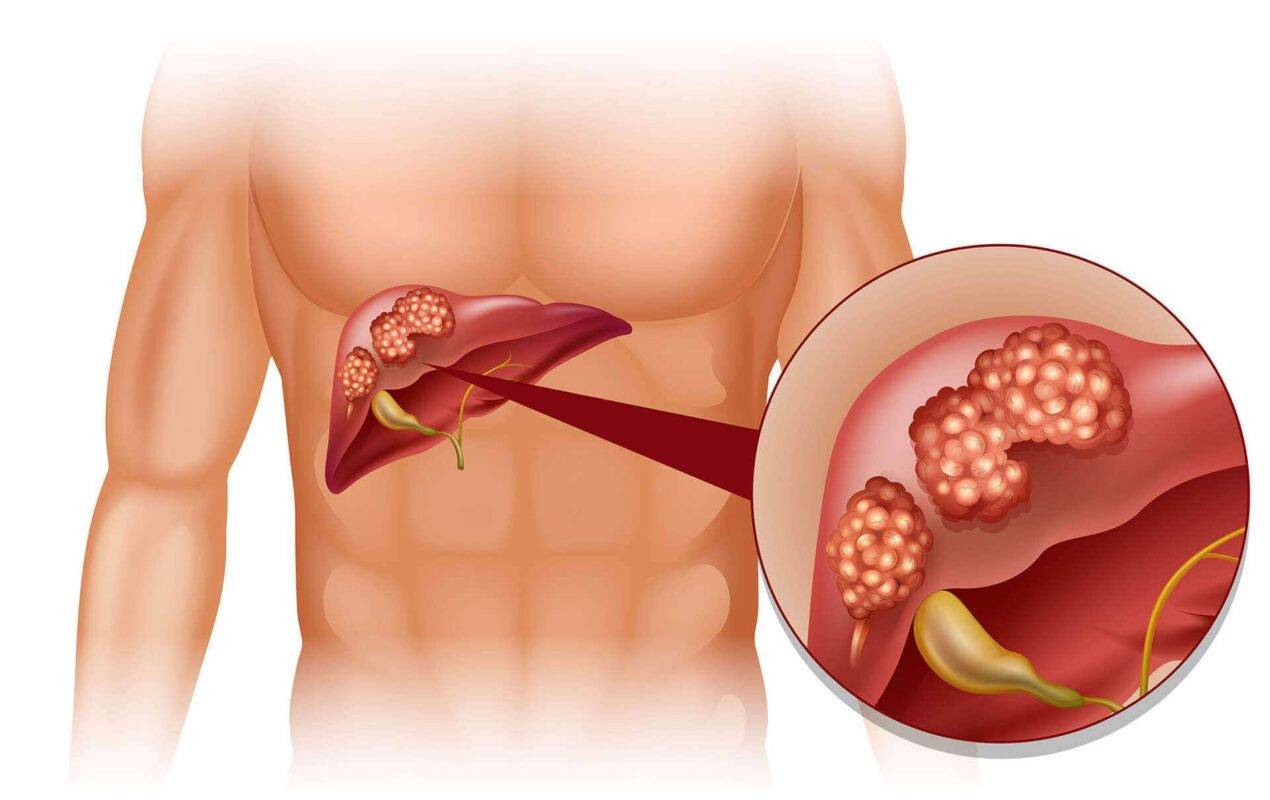 What is Liver cancer ?