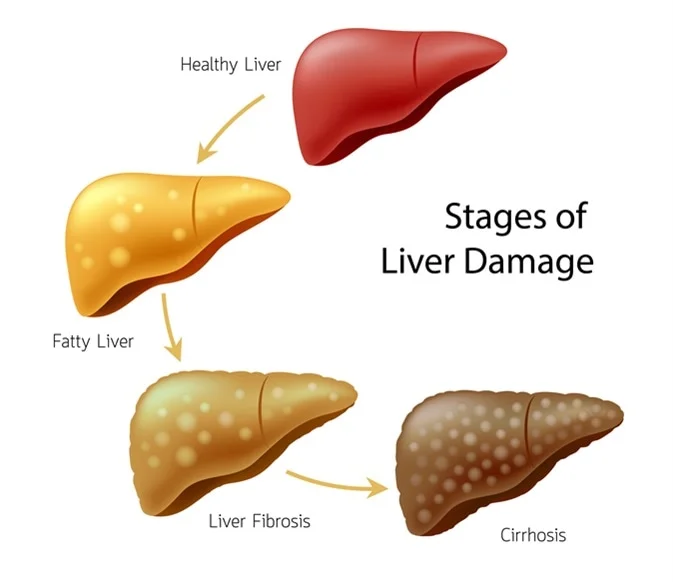 What is Liver disease ?