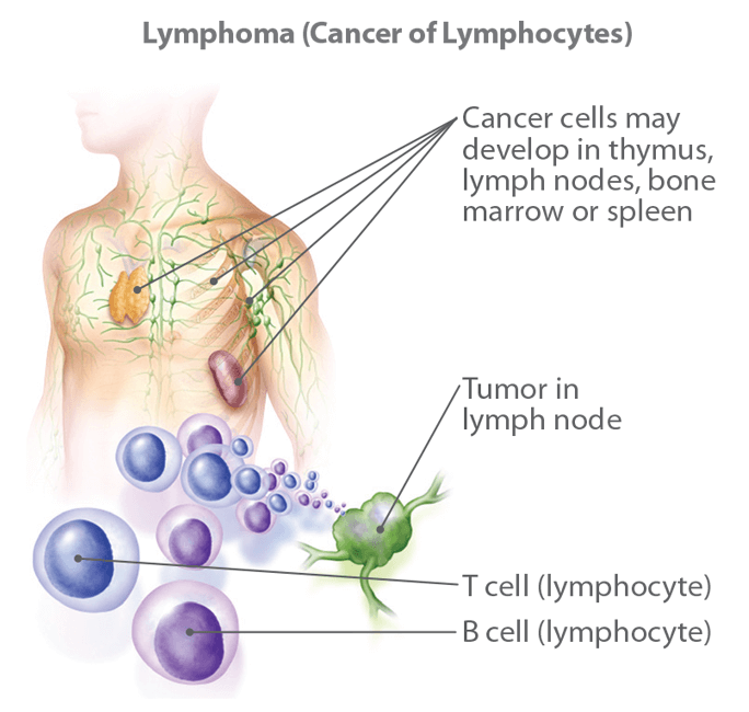 What is Lymphoma ?