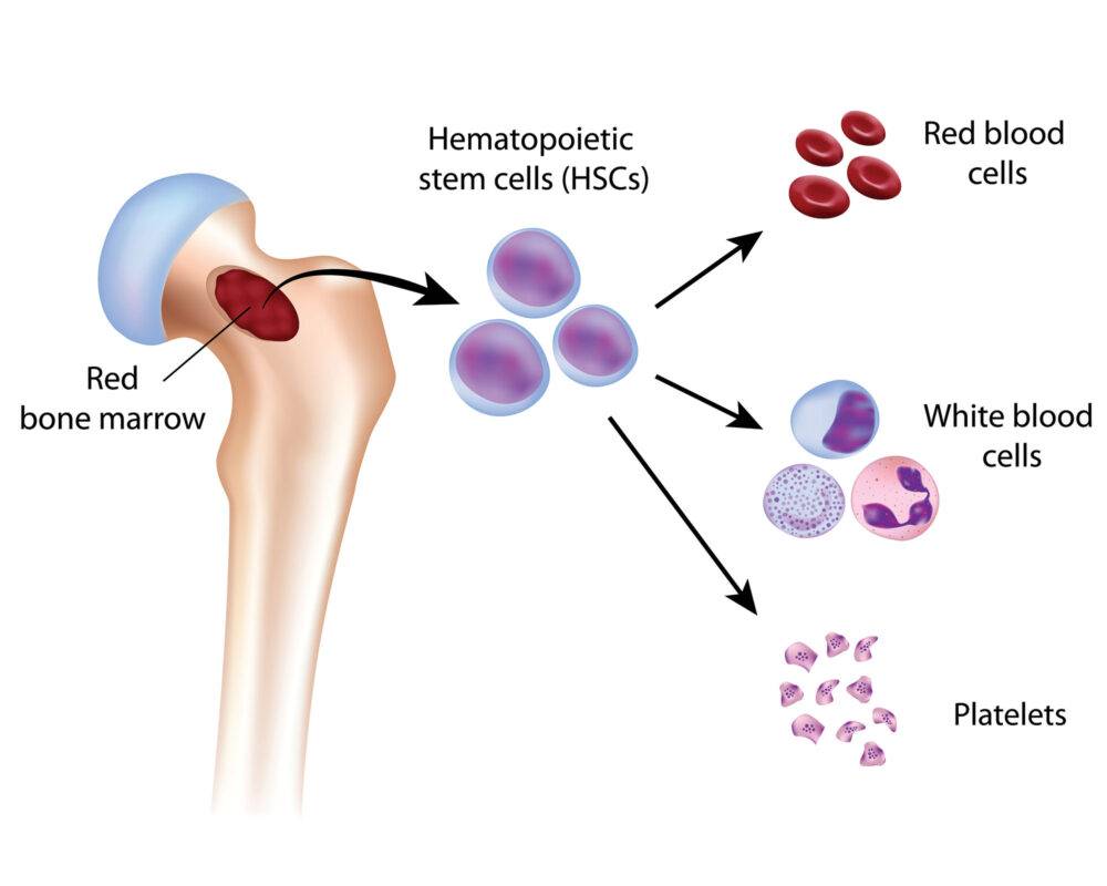 What is Myelodysplastic syndromes ?