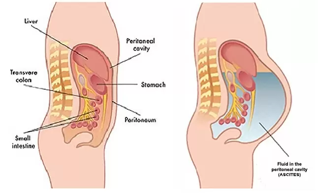 What is Peritoneal Cancers?