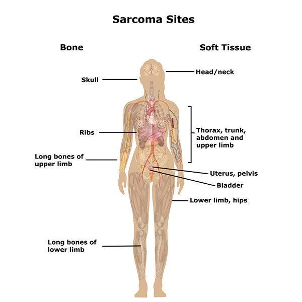 What is Soft Tissue Sarcoma ?