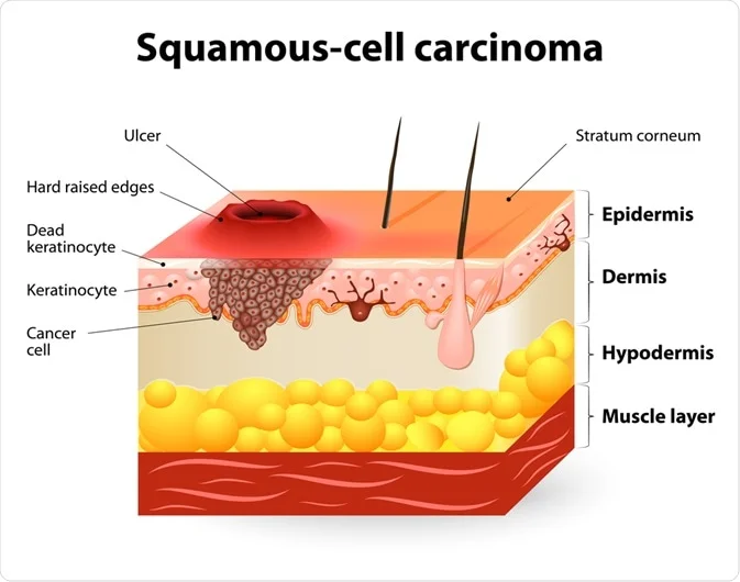 What is Squamous Cell Cancer ?