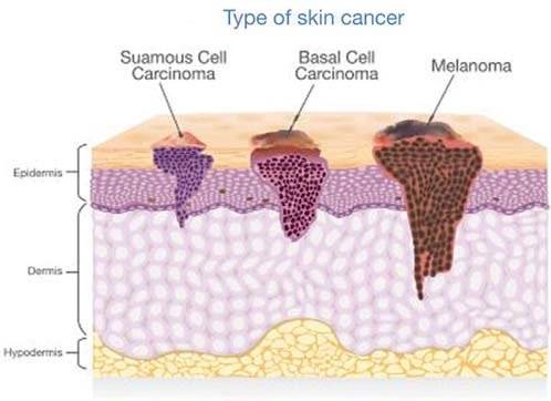 what is Skin cancer?