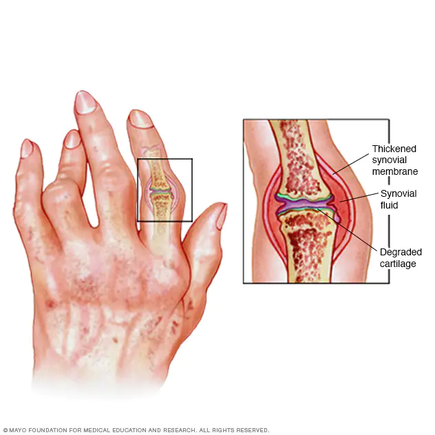 What is Rheumatoid arthritis?