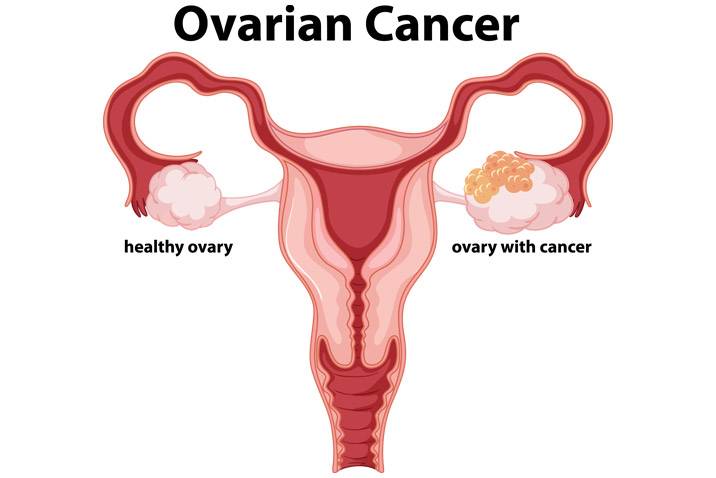 What is Ovarian cancer ?