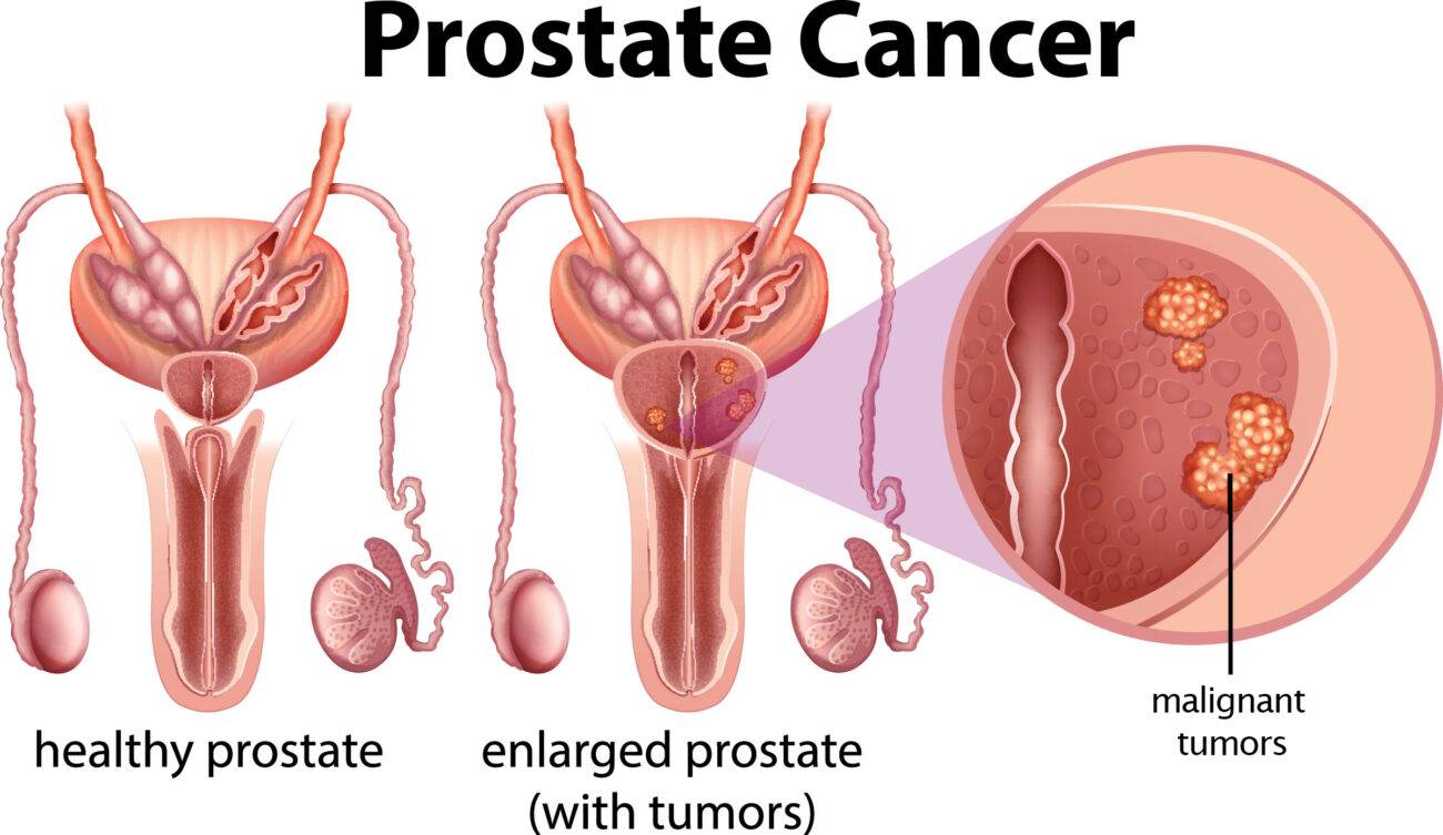 What is Prostate cancer?