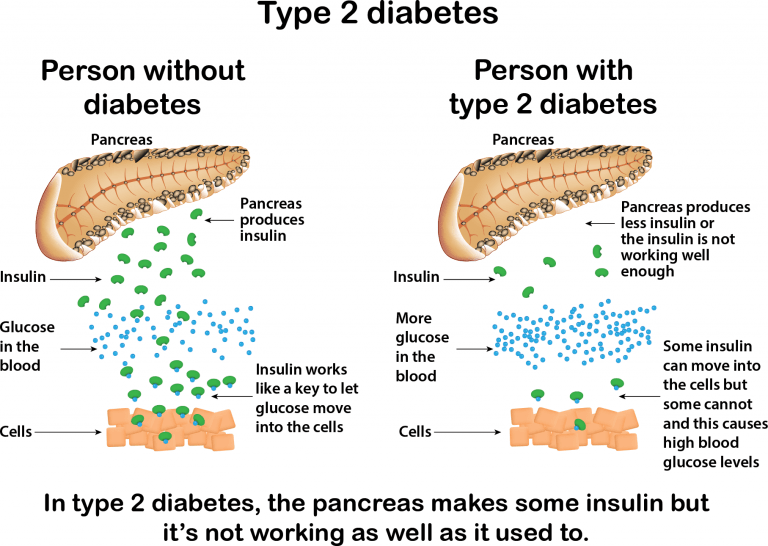 What is Type 2 diabetes?