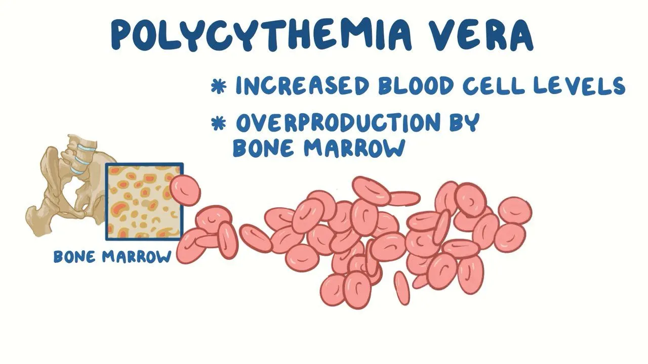 What is Polycythemia vera?